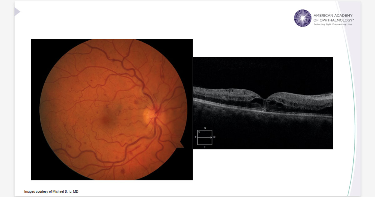 American Academy of Ophthalmology tweet media