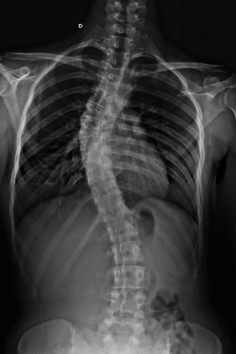 cauhsensei's tweet photo. @jakypinho @gmelvianna evito, não corro e etc) eu fiz um ano de musculação e pilates antes de realizar a cirurgia, tenho certeza que isso foi determinante pra como eu estou agora, preparar a musculatura me ajudou mt na uti e no pós 

como era antes, eu tinha 47 graus em cima e 31 na curva debaixo: https://t.co/2xClEW0ftp