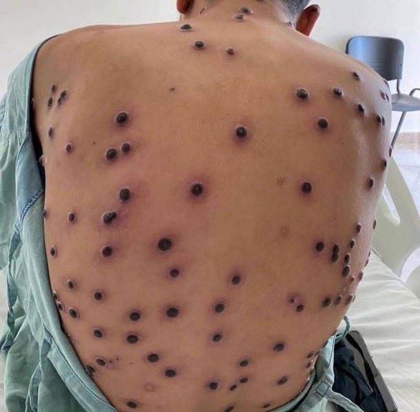"Ain detergente ype tem bacterias"

A mesma pessoa voltando do Carnaval: