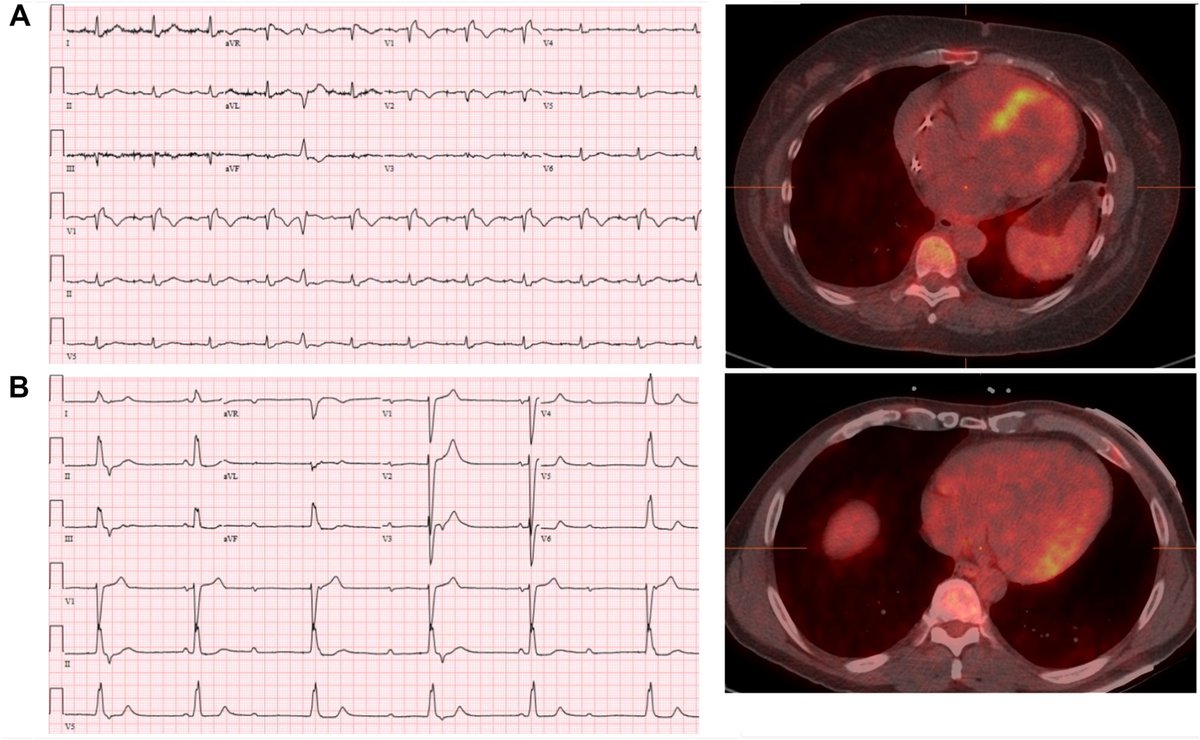 Heart Rhythm O2 tweet media
