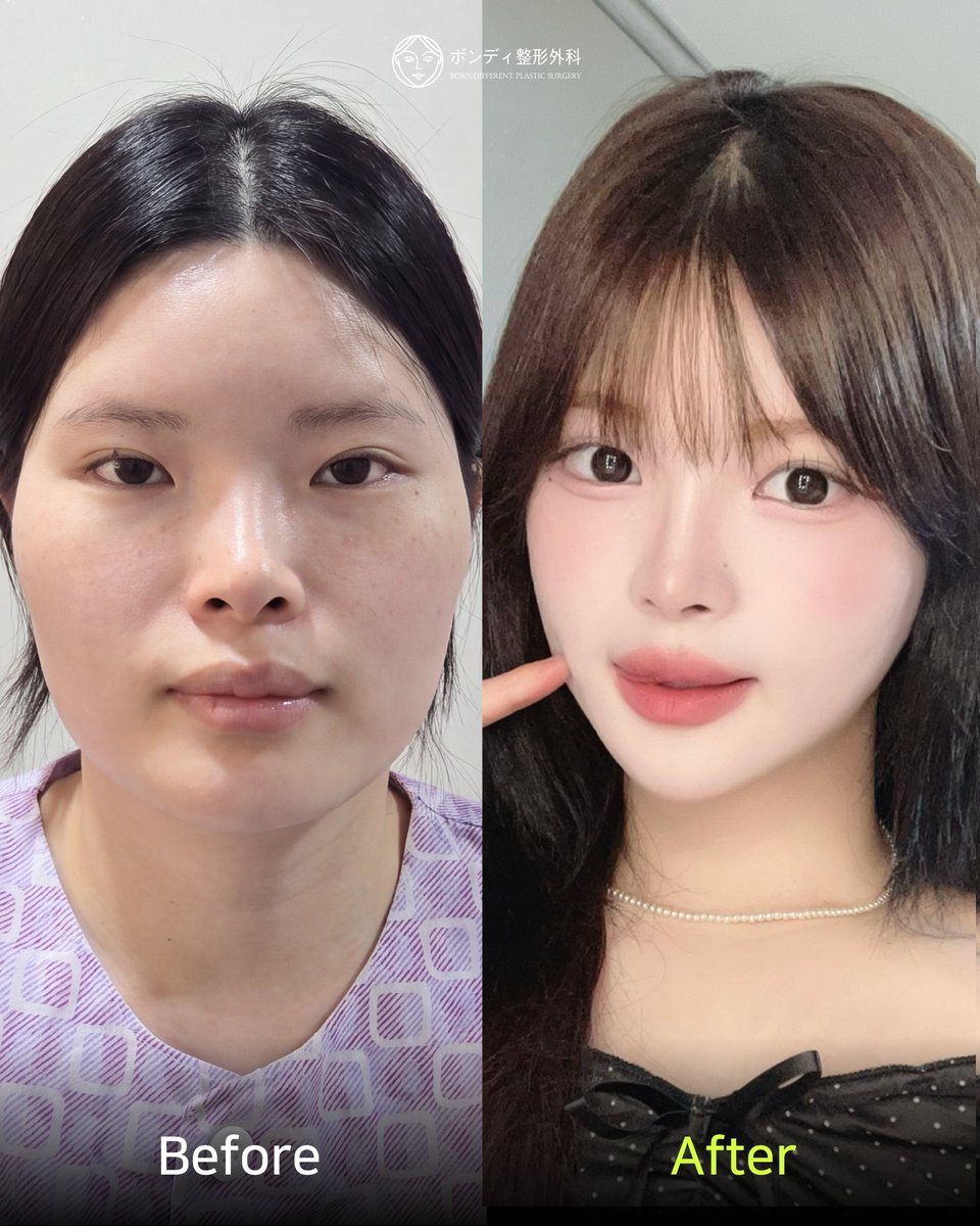 韓国ボンディ美容整形外科 BORN:DI PLASTIC SURGERY tweet media