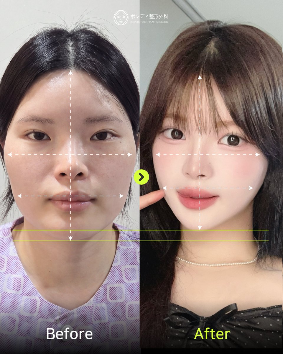 韓国ボンディ美容整形外科 BORN:DI PLASTIC SURGERY tweet media