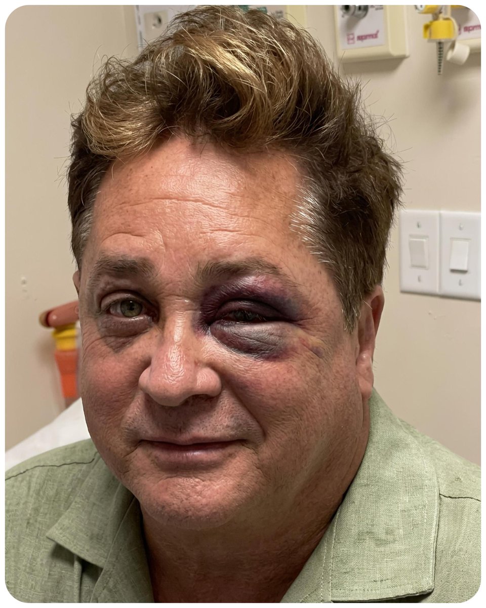 sertanejonanet's tweet photo. Leonardo contou que estava “mamado” quando sofreu a queda que deixou seu olho roxo e brincou que não sentiu dor porque estava anestesiado pela bebida 😂 https://t.co/jgtT2GorOm