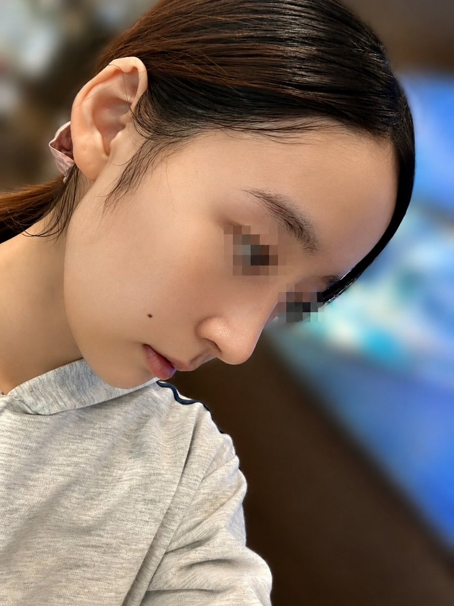 protocol2045763's tweet photo. リターニングで鼻整形して7日目です！
曲がっていた鼻が真っ直ぐになり感動です✨
まだまだ腫れているので、完成形が楽しみです𛰙᭜𖫴𖫰𖫱𖫳𖫲𖫲𖫳𖫴𖫰𖫱꛰ ᭜𖫴𖫰𖫱𖫳𖫲𖫲𖫳𖫴𖫰𖫱꛰♥ https://t.co/4dZ0ME0Uqi