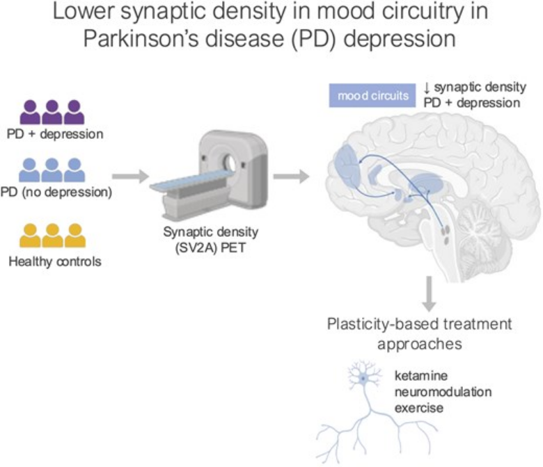 ScienceofPD's tweet photo. Researchers present "the first in vivo evidence that lower synaptic density in mood-related brain regions may contribute to depression in #Parkinsons"; SV2A PET imaging finds synaptic density was -vely correlated with the severity of depressive symptoms
https://t.co/Le03S0wwJ6 https://t.co/BYSHu45eUM