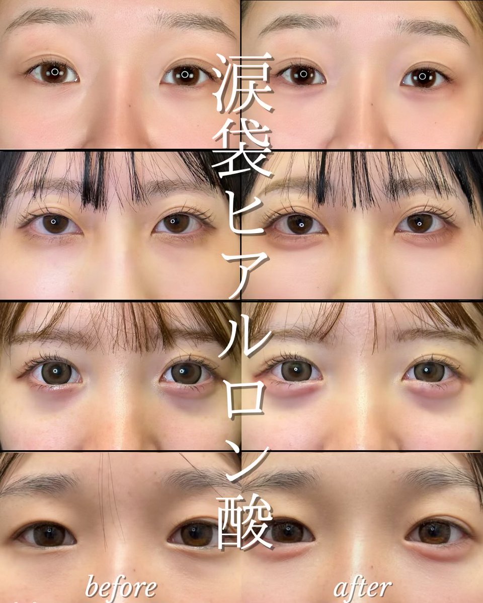 lbc_drnoto's tweet photo. ルラ美容クリニック大通院能登貴弘
【施術内容】涙袋ヒアルロン酸
【価格】
ボリフト ￥55,000(税込) 
ボルベラ ￥66,000(税込) 
マイクロカニューレ代 別途7,150円 税込
【リスク】腫れ、内出血、感染
ご予約は下記リンク
https://t.co/QAclSHpcmB
#ルラ美容クリニック札幌大通院
#ルラ美容クリニック https://t.co/sfNbdXdHuY