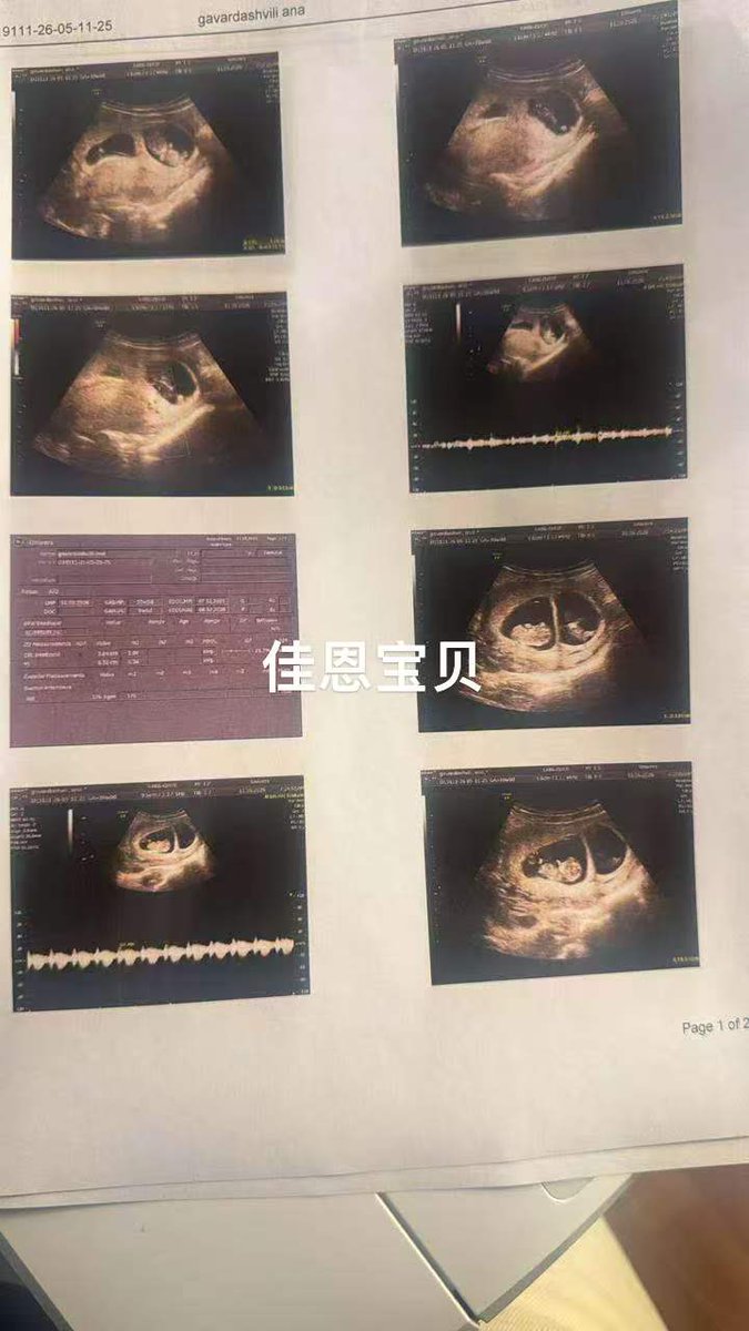 Bellaliuivf's tweet photo. 【格鲁吉亚】10周了！#kid #Ukraine #不孕 #试管 #乌克兰 #donors #格鲁吉亚 #吉尔吉斯 #biotex #洗精 #单身 #同志 #哈萨克 #彩虹 #代孕 咨询微信：Bellaliuliu ， haydonge whatsapp: 08615250270086, 08613912655230 https://t.co/u6ZPNF8lr1