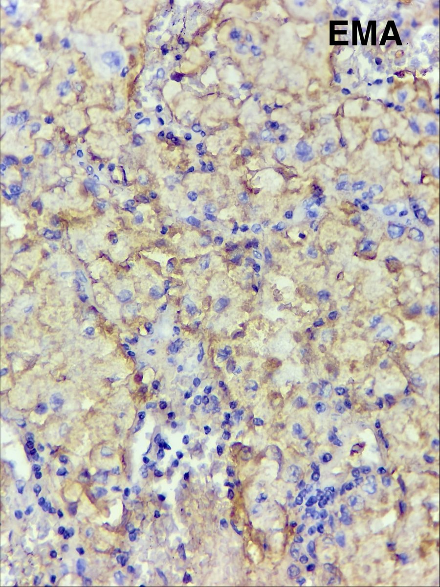 megha_lalcheta's tweet photo. Pax 8, AE1/AE3, CK7  → Negative
CD10, CAIX, EMA, vimentin → Positive

#ENTPath https://t.co/2bu6ixPrhh