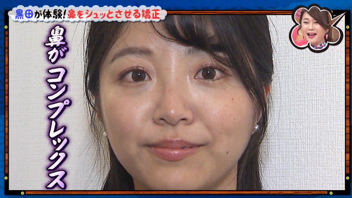 raplit_amn's tweet photo. 番組では、
黒木千晶さんも施術をご体験♪

黒木アナご自身から
「鼻がコンプレックス」と。

施術は少し痛かったようですが

黒木アナ
「鼻高くなるためなら我慢する」
というコメントも♪

施術開始から約10分後…

「鼻高なってるわ」と撮影現場で盛り上がり♪　

取材ありがとうございました🙇 https://t.co/FKXMweYdOD