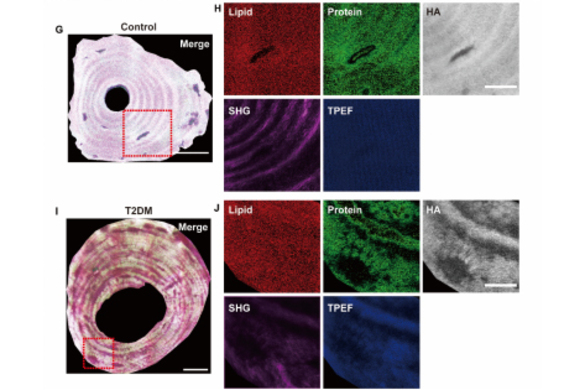 OptoElectronAdv's tweet photo. #OEA_highlight AI-powered nonlinear optical imaging reveals protein spatial homogenization as an indicator of impaired bone quality in type 2 diabetes https://t.co/JfyXlAGviG by Prof. #Ting_Li #Chinese_Academy_of_Medical_Sciences #label_free #imaging #diabetes #bone #AI https://t.co/YwIqrddtws