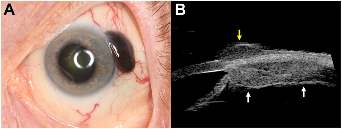 AAOjournal's tweet photo. A 74-year-old man presented with a pigmented tumor on the left eye suspicious for conjunctival melanoma. Visual acuity was 20/50. The anterior segment demonstrated a pigmented mass covered by the conjunctiva and Tenon’s fascia (A), with numerous episcleral sentinel vessels suggesting underlying intraocular tumor. Gonioscopy disclosed 360° angle pigmentation and fundoscopy showed a peripheral melanoma, with subtle ciliary body involvement on ultrasound biomicroscopy (B, white arrows), measuring 3.9 mm thickness. Findings represented a small ciliochoroidal melanoma with large extraocular extension (B, yellow arrow) and angle invasion. There was no primary conjunctival melanoma. Plaque radiotherapy was performed.
https://t.co/oJqoEVHpCI
#ophthalmology
