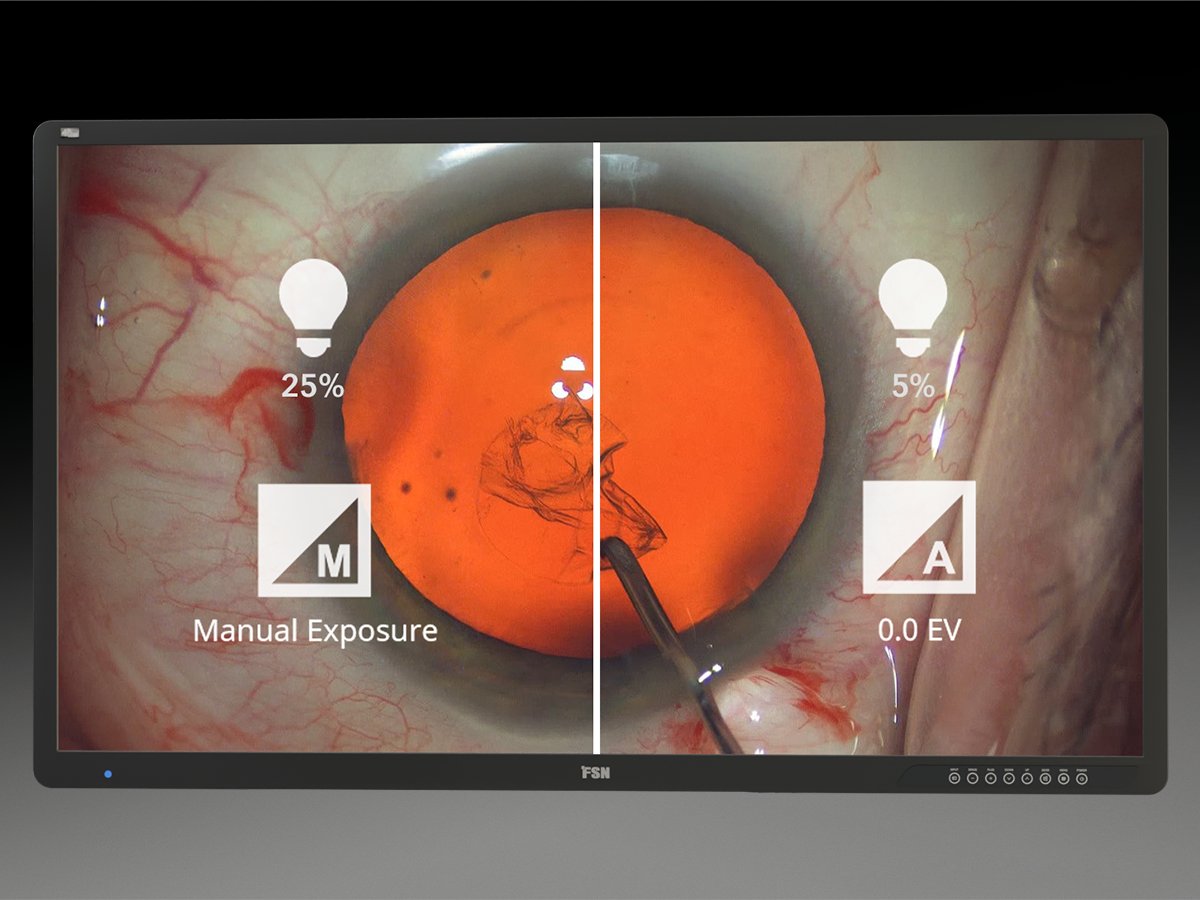 HSDiagnostics's tweet photo. Our new METIS 3D Digital Heads-Up Module (METIS HU) offers many benefits to surgeons – while also increasing patient comfort by enabling procedures to be carried out at lower light levels compared to an analog microscope setup: https://t.co/Av1gdWoOqP
#haagstreit #metis https://t.co/PEfmwgnDkR