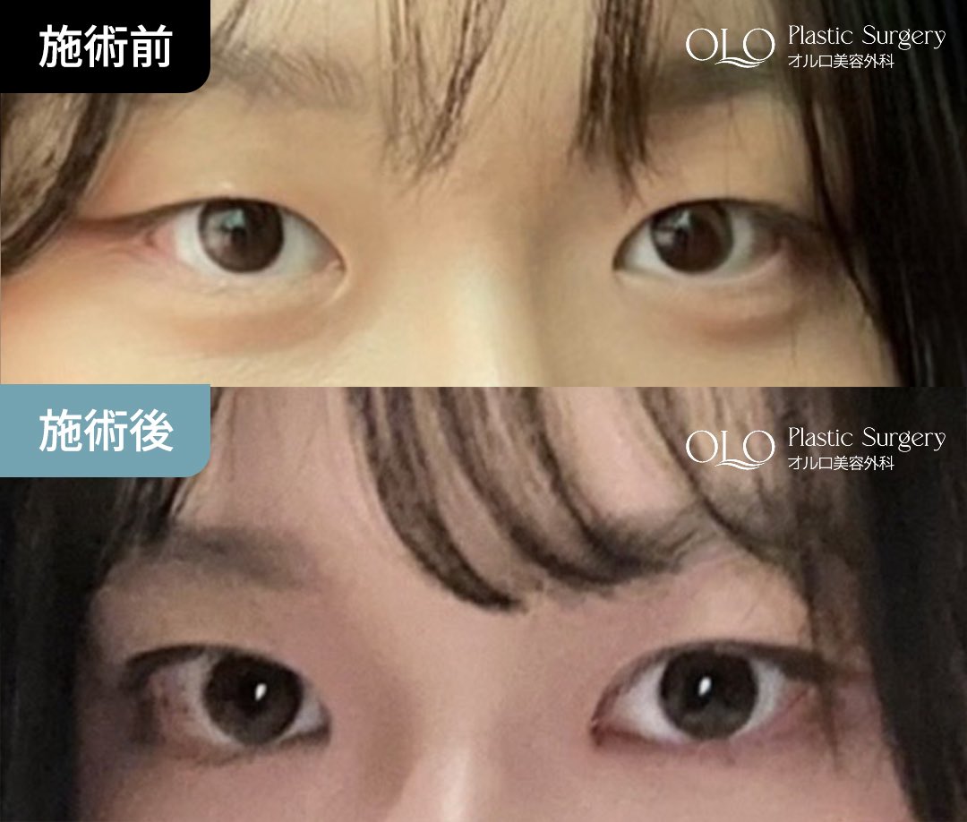 【公式】オルロ美容外科 | 逆さまつげ手術専門 tweet media