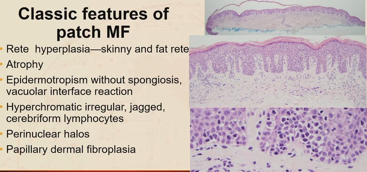 Janiranavarro's tweet photo. Classic features of patch mycosis fungoides

- Rete hyperplasia - skinny and fat rete
- Atrophy
- Epidermotropism without spongiosis
- Perinuclear halos
- Hyperchromatic, irregular, jagged lymphocytes
- CD4:CD8 increased at least 4.5:1

Dr. Junkins-Hopkins #USCAP2026 #pathology #PathX #PathTwitter