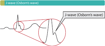 PeterItebimien's tweet photo. Osborn waves 
Hypothermia 
Osborn waves (or J waves) are distinctive electrocardiogram (ECG) deflections, often called "camel-hump signs," occurring at the junction between the QRS complex and ST segment (the J point). Primarily associated with severe hypothermia (<32°C or 90°F), they appear as positive deflections in precordial leads (V2-V6) and are caused by abnormal myocardial repolarization.