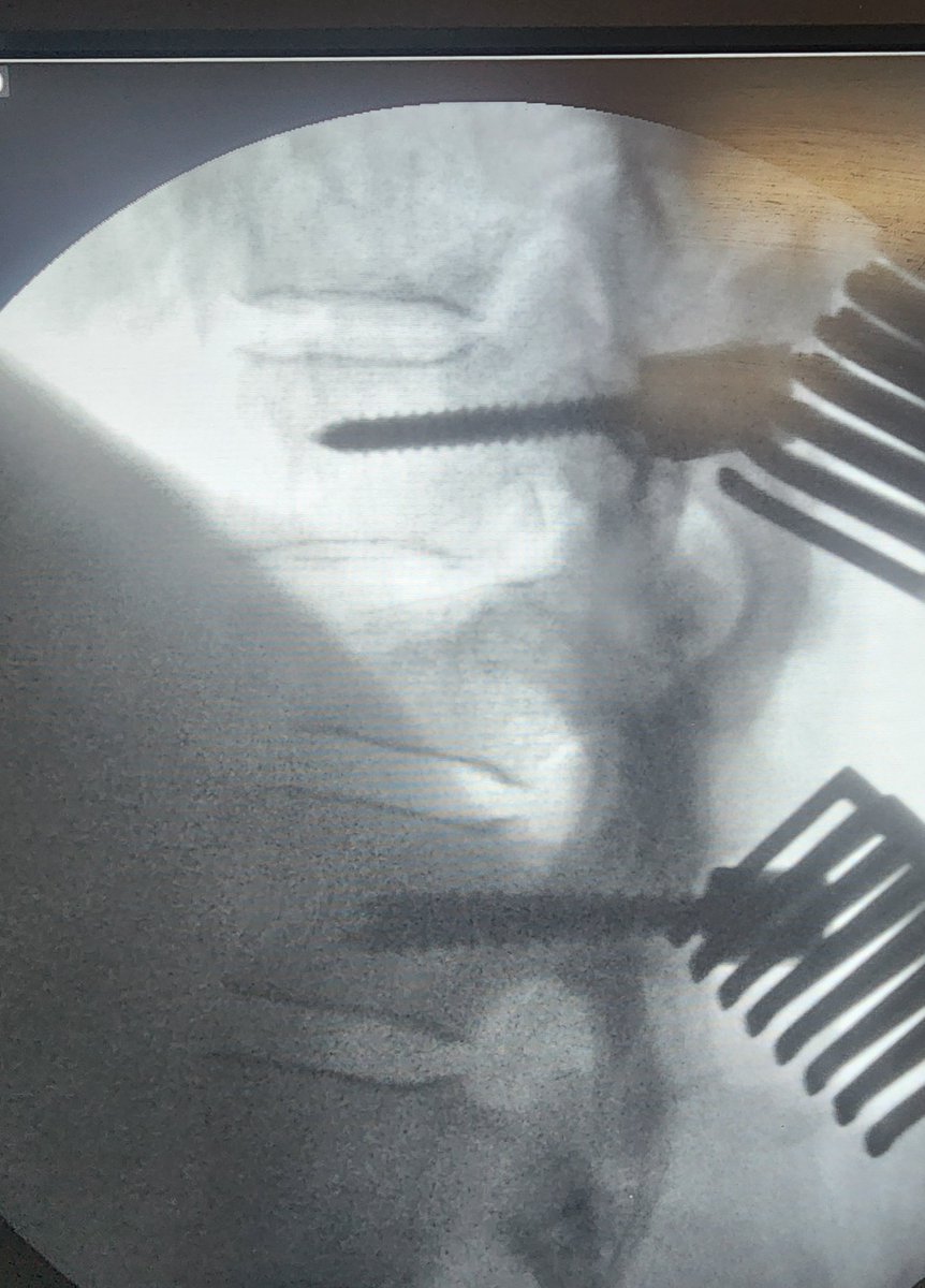 BeyondTheOR's tweet photo. 46-year-old male presented with traumatic D11 vertebral fracture with spinal cord contusion.

Neurology on presentation:
Upper limbs: 5/5 bilaterally
Lower limbs: 0/5 bilaterally

He underwent D10–D12 pedicle screw fixation and stabilization with D11 laminectomy.

This case highlights the importance of early neurological documentation, careful level localization, posterior stabilization across the fractured segment, and decompression when indicated in traumatic thoracolumbar spine injury.

#Neurosurgery #SpineSurgery #SpinalTrauma #PedicleScrewFixation #Laminectomy #Neurotrauma #Spine