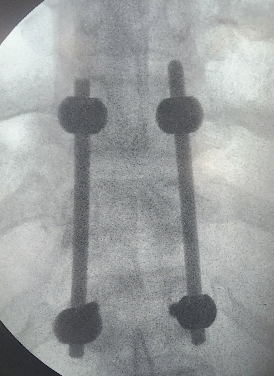 BeyondTheOR's tweet photo. 46-year-old male presented with traumatic D11 vertebral fracture with spinal cord contusion.

Neurology on presentation:
Upper limbs: 5/5 bilaterally
Lower limbs: 0/5 bilaterally

He underwent D10–D12 pedicle screw fixation and stabilization with D11 laminectomy.

This case highlights the importance of early neurological documentation, careful level localization, posterior stabilization across the fractured segment, and decompression when indicated in traumatic thoracolumbar spine injury.

#Neurosurgery #SpineSurgery #SpinalTrauma #PedicleScrewFixation #Laminectomy #Neurotrauma #Spine
