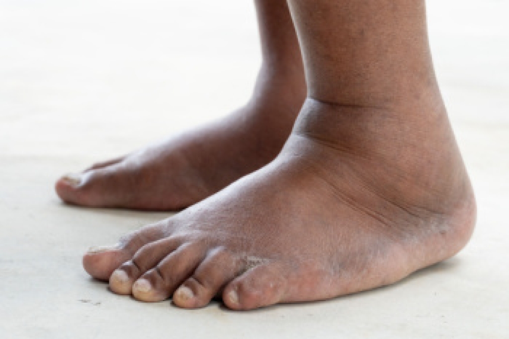 Elite_Podiatry's tweet photo. When Swelling Develops in the Feet and Ankles https://t.co/ptdr1C0ba5 https://t.co/jbc5DQdW3U