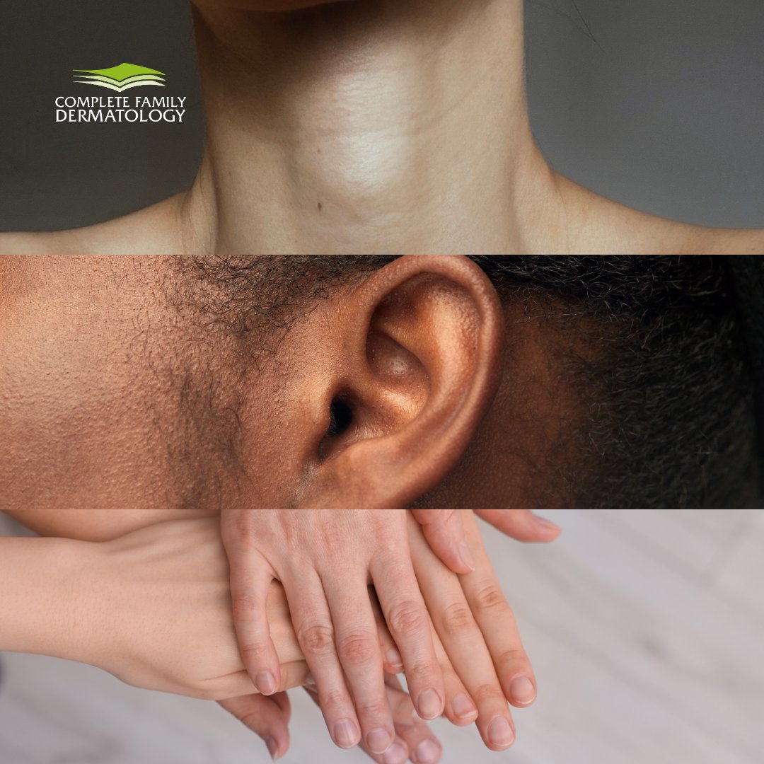 CompleteFamily7's tweet photo. Don’t forget the most neglected areas of your skin! ✨

Spots like your neck, ears, and hands are often overlooked but show signs of aging and sun damage quickly. Give them the care they deserve, too! 💚

#skin #skincare #clinic #dermatologyclinic #derma #dermatology https://t.co/2bl8PLrdhP
