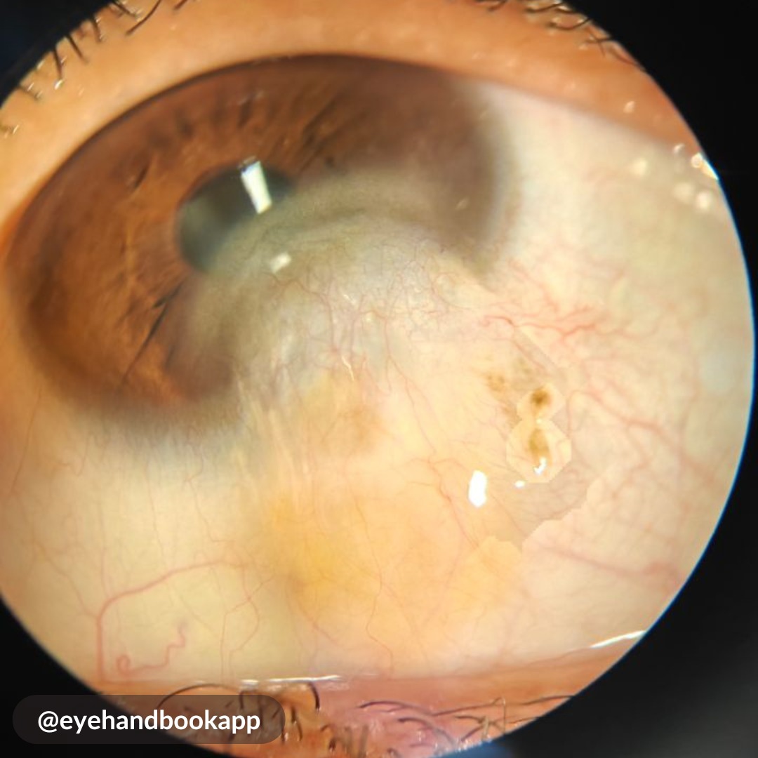 EyeHandbook's tweet photo. How will you manage this case?
Can you guess the pathology this patient had for which she underwent a surgery 7 years back.
#eyes #cornea #clinicalcalculators #eyecalculators #eyeatlas #ophthalmologist #optometrist #eyedoctors #ophthalmology #optometry #cornea  #retina https://t.co/0ZxyeVFjWL