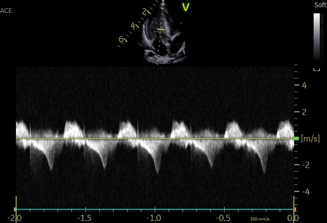 Irina67790690's tweet photo. ❗️
2‑month‑old baby with Hypertrophic Cardiomyopathy and mid‑ventricular obstruction. https://t.co/WzAKVOizCH