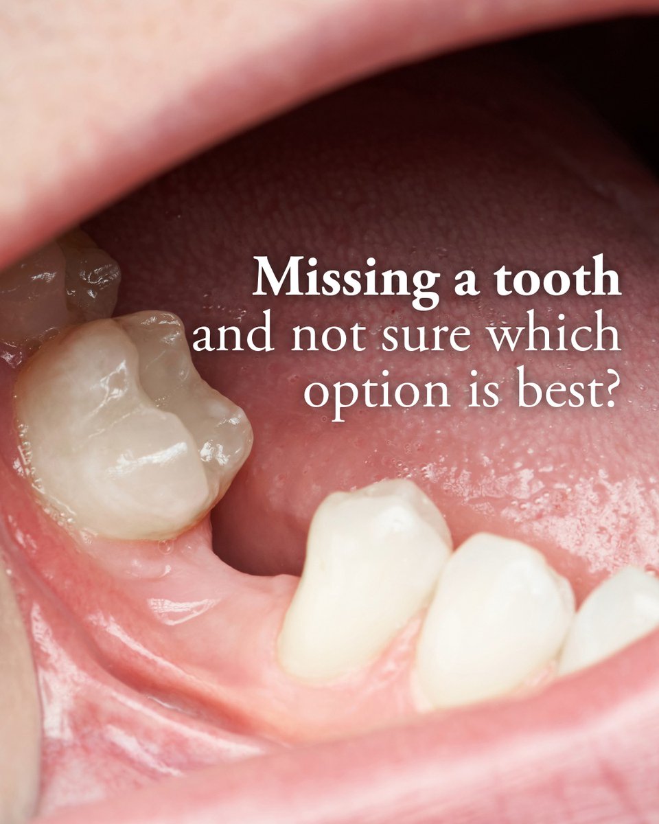 CreativeDentATL's tweet photo. Missing a tooth and not sure what’s best? Implants, bridges, and other options can all be worth considering depending on your needs. Start with a consultation. 

#MissingTooth #ToothReplacement #DentalImplants https://t.co/l4lnghipJN