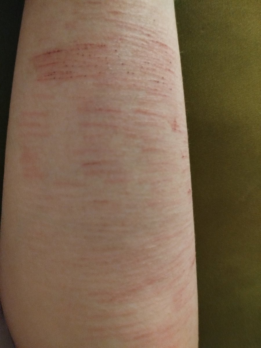 Axelshtwtaq's tweet photo. #988twt #shtwt #selfharm
I hate my life i cant even cut properly. I want to go to styro but i have dull blades like this blades that i cut with today were pretty new and are already dull 🫩. I need something sharp asap. Anyway heres some shity pics of my thigh. https://t.co/ZExqRI9wWh