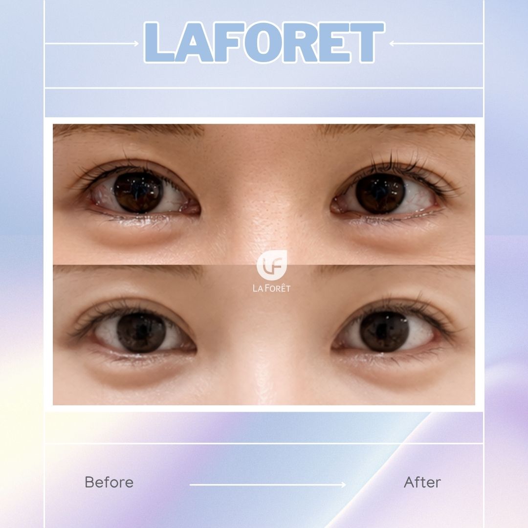 laforetjp's tweet photo. 「目頭切開をしたら不自然になった」
「傷跡や寄り目感が気になる」
「以前の優しい印象に戻したい」
そんなお悩みに、
ラフォーレ美容外科の【目頭再建】。
ただ戻すだけではなく、
顔全体のバランスまで考えた
繊細なデザインで、
自然で上品な目元へ。

ラフォーレ美容外科
目頭再建モニター募集中 https://t.co/JtgUUtUV7l