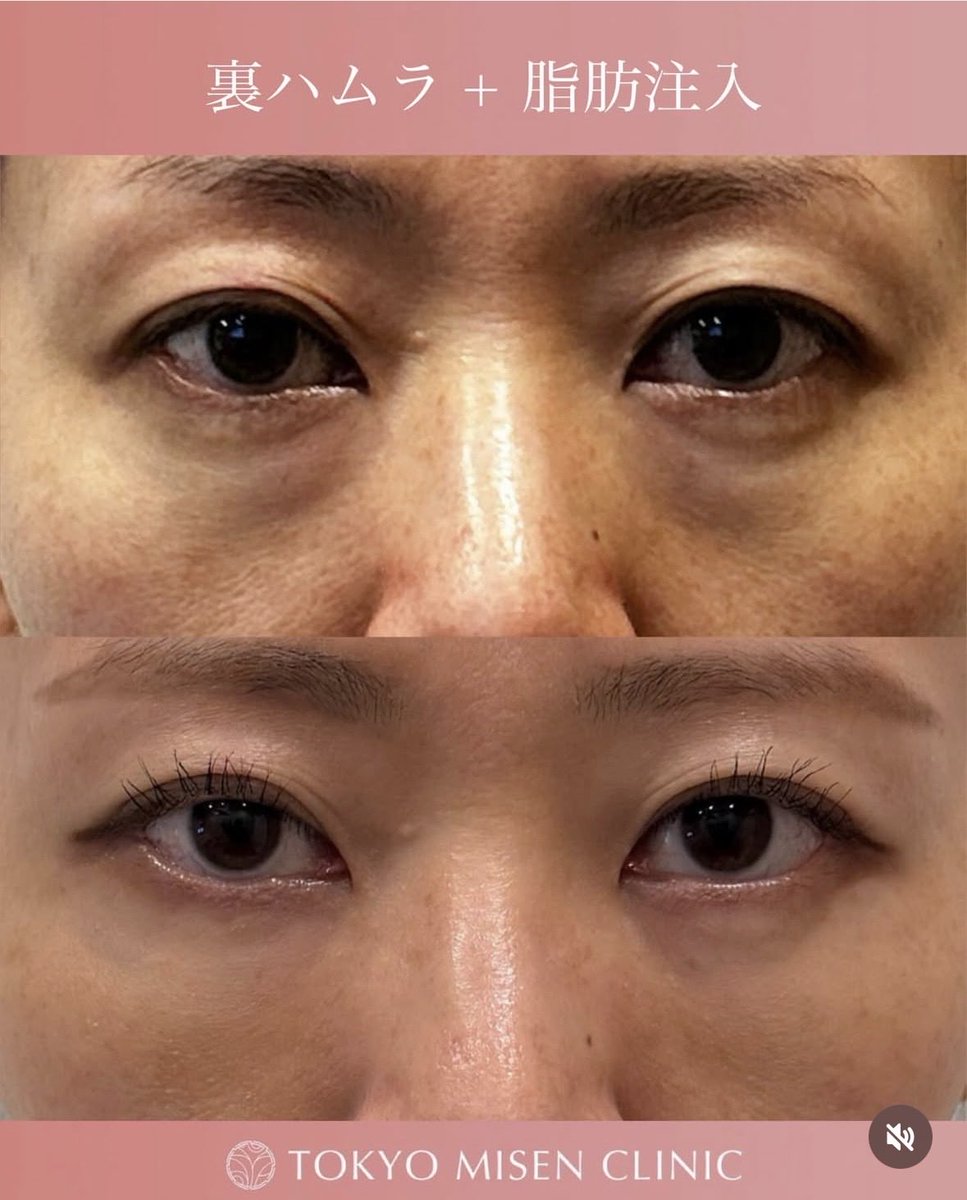 土田諒平(鼻/クマ/脂肪吸引) 東京美専クリニック渋谷院院長 tweet media