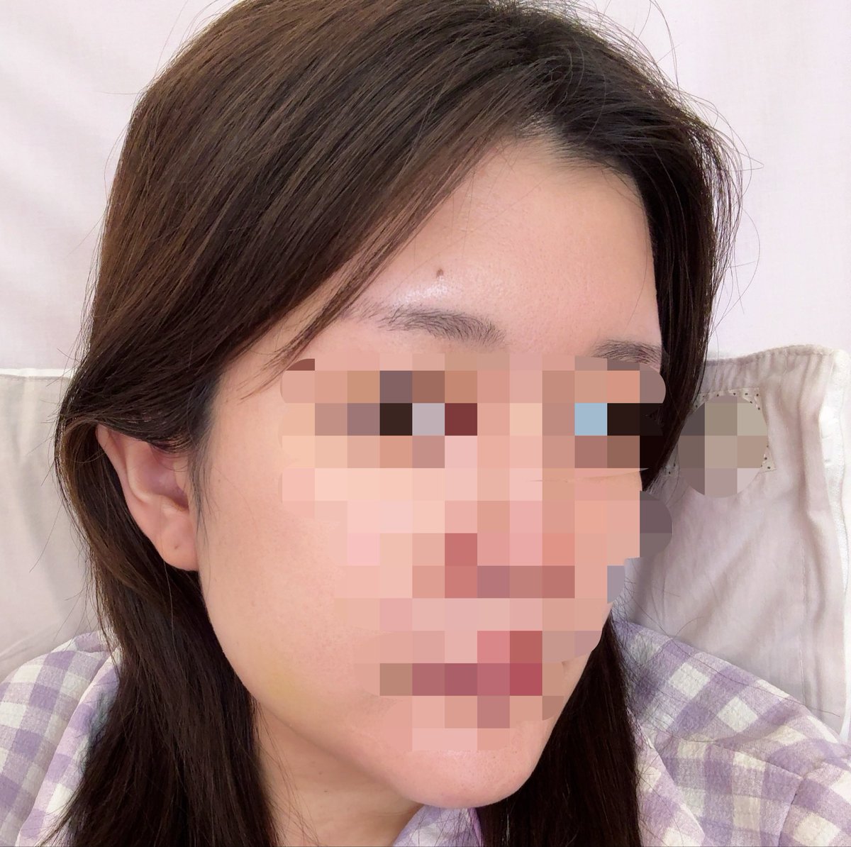 顎変形症✩りん✩2026.5.7両顎手術済み tweet media