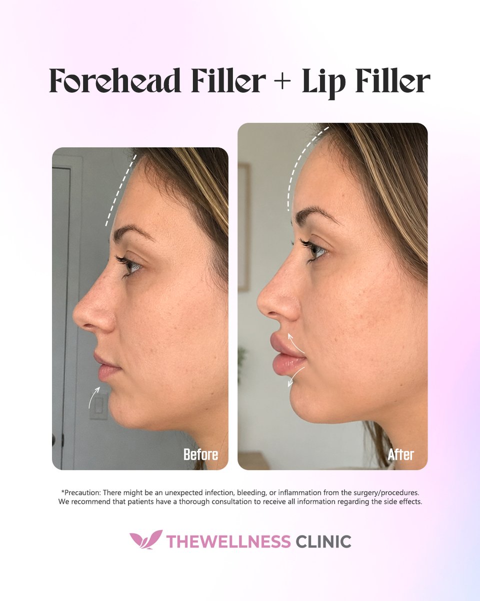 thewellnessen's tweet photo. The Power of the Profile!
Watch a bold, high-definition transformation:
🔹 Forehead Filler: Creates a smooth "S-line" for a balanced profile
🔹 Lip Filler: Bold volume and definition for a striking, glamorous look
Redefine your signature silhouette!👇
#ForeheadFiller #LipFiller https://t.co/FMbBJOQHpB