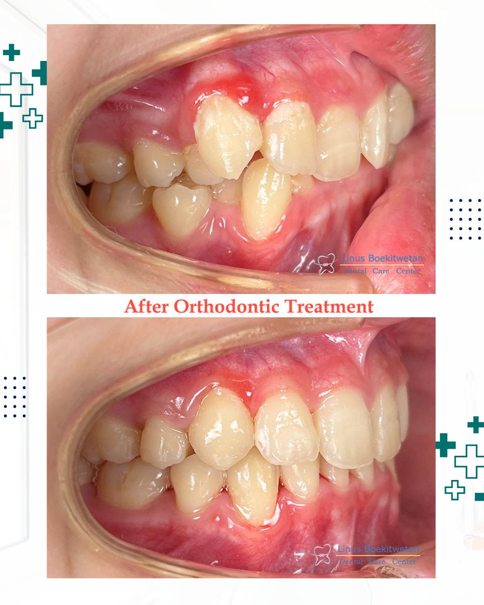 DrgLinus's tweet photo. No filter, just confidence

#bracesoff #drglinus #beforeafter #behelgigi #clearaligners https://t.co/yKMOuKDkOp
