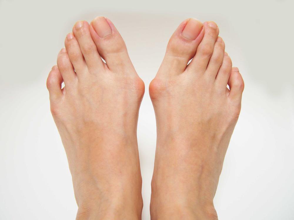 a_malik21's tweet photo. انحراف إبهام القدم (Bunion / Hallux Valgus)

ليس مجرد “بروز عظمي”
هو تشوه تدريجي يؤثر على توزيع الضغط والمشي واختيار الحذاء، وقد يسبب آلامًا بمقدمة القدم كاملة مع الوقت
الحلول هي الجراحة فقط 

#الدكتور_عبدالملك_البكر_استشاري_جراحة_القدم_و_الكاحل https://t.co/code0a7vbH