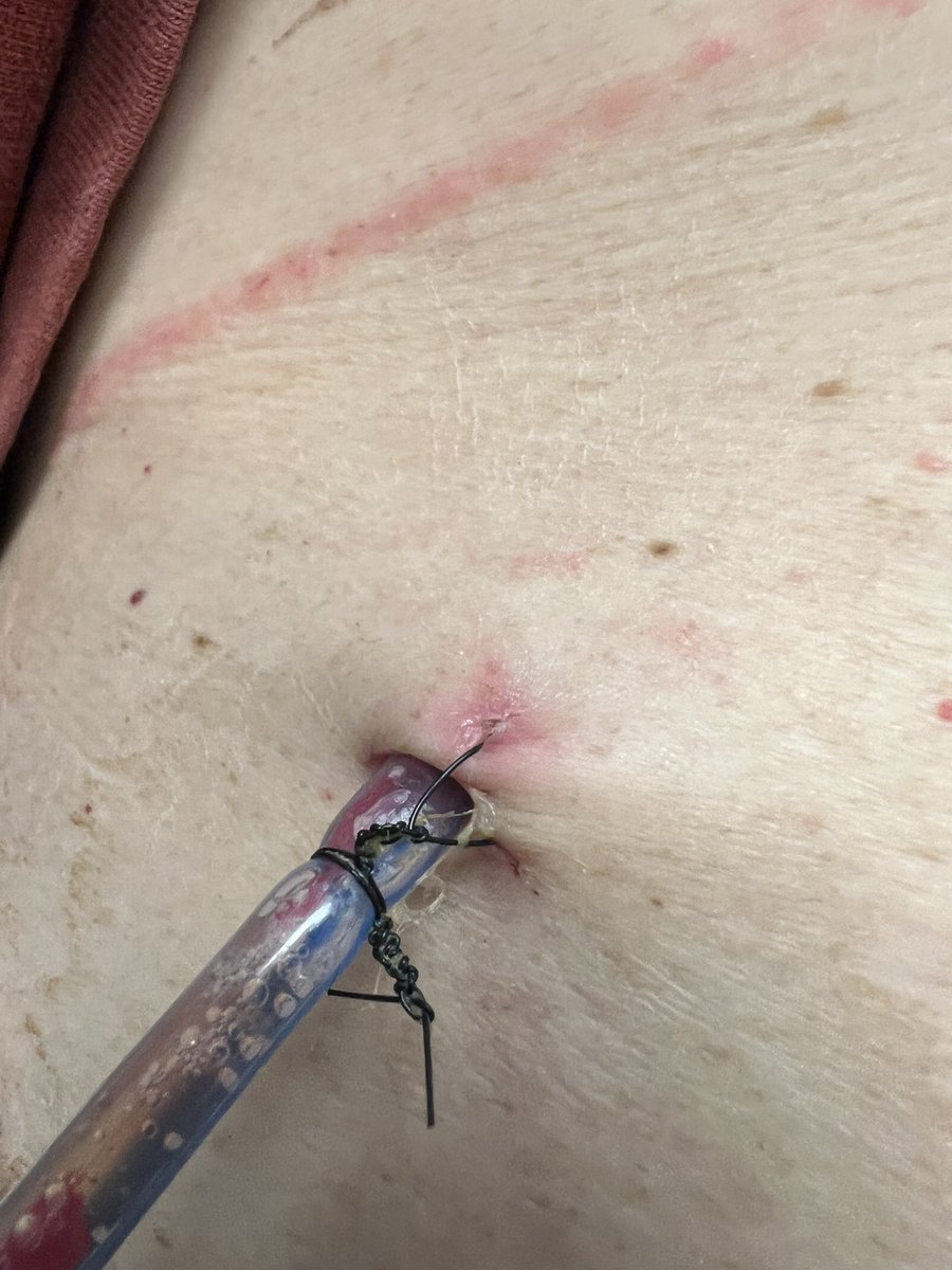 EricKnauerMD's tweet photo. @PipeCabreraV @AmJSurgery @SWexner @pferrada1 @TomVargheseJr @AmCollSurgeons @juliomayol @CiruAndes2 1. Air knot at the skin for easy removal
2. Wrap each leg of suture around once
3. Tie tight enough to slightly dimple the tube https://t.co/tRvQRggoXU