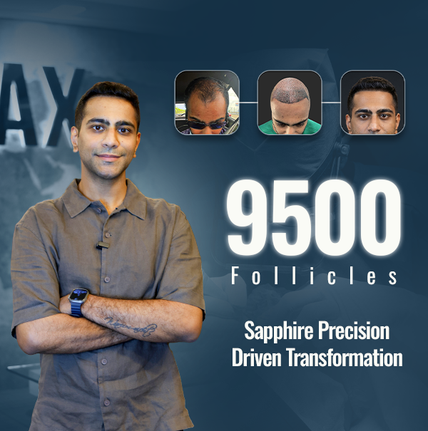maxclinicglobal's tweet photo. 9500 follicles
One transformation
Precision placed, naturally aligned and designed for long-term density

#HairTransplant #SapphireFUE #HairRestoration #MaxHairClinic #HairlineTransformation https://t.co/bEnXCrPwwg