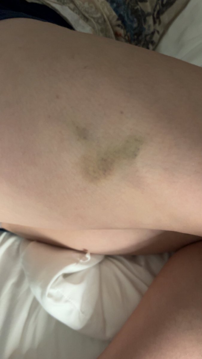 pack_ofkoolz's tweet photo. #hiddenmickey bruise https://t.co/g7giQV8PdC