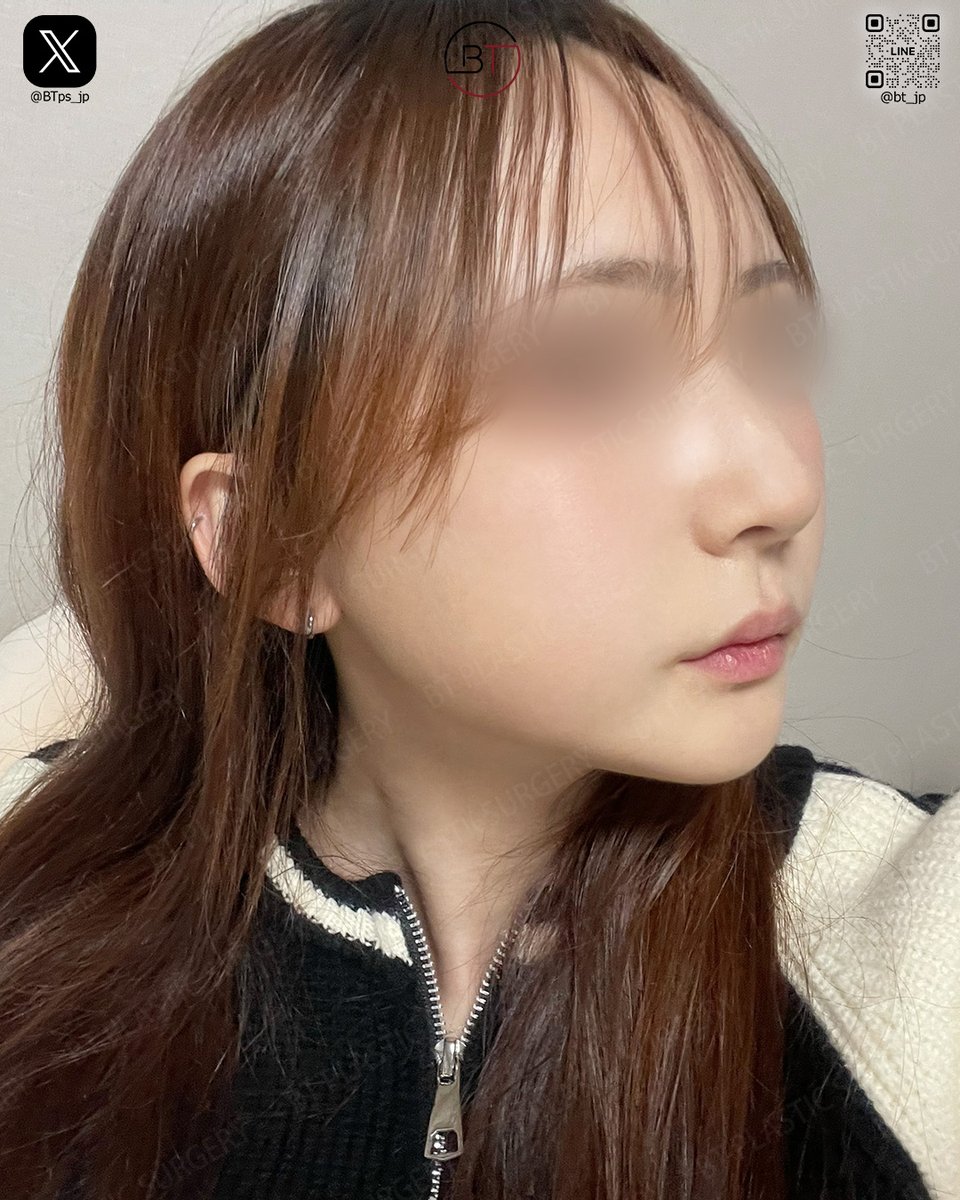 韓国BT整形外科「輪郭と鼻手術専門」 tweet media