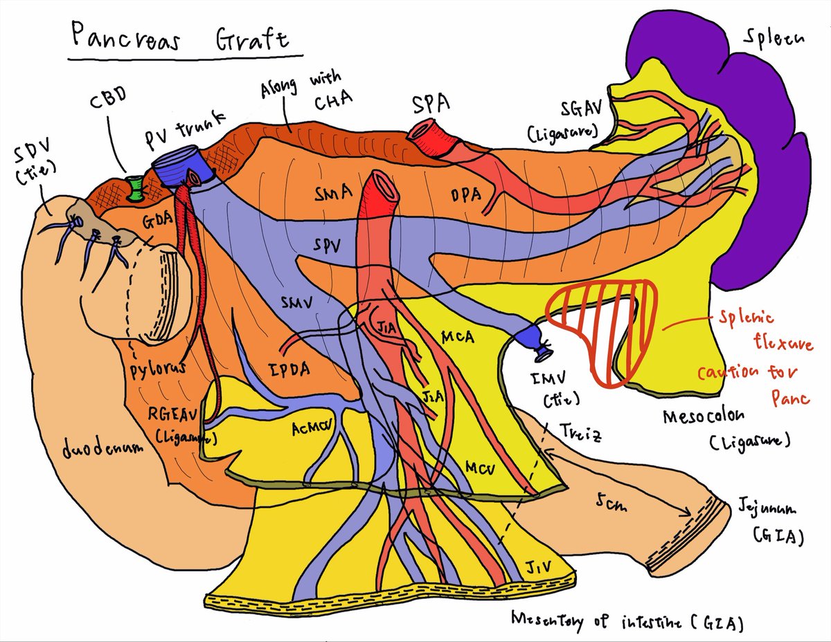 ToruGotoMD's tweet photo. When you perform pancreatic resection, pancreas procurement is one of the best textbooks.

It teaches every essential step: vascular anatomy, mobilization, dissection planes, lymphovascular control, and how to respect the pancreas. https://t.co/tdDj7cM8aA