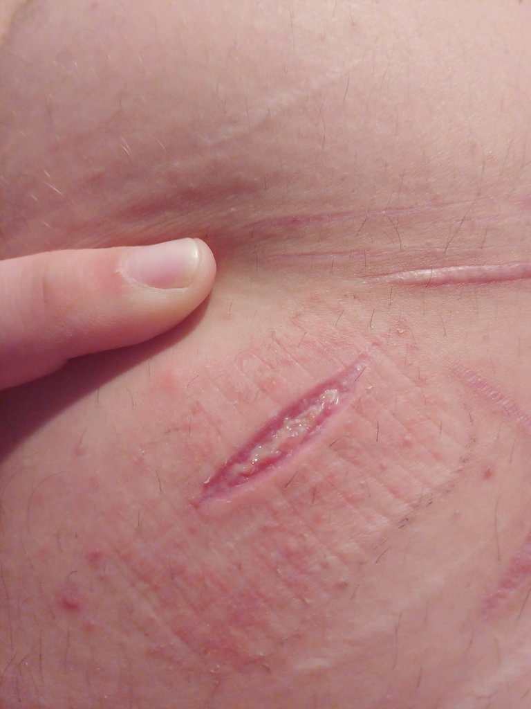 atsushistiger's tweet photo. Is this infected?? Also ignore the irritation around it idk wtf happened its had second skin on it for a week or smth #shtwt https://t.co/diTNWFifhI