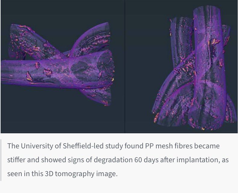 SusanMorgan19's tweet photo. 🚨Two landmark studies expose the truth about polypropylene (#PP) #mesh:
• Sheffield University 2024 (sheep model): PP mesh fibres begin degrading within 60 days — surface oxidation, stiffening and debris accumulation worsen by 180 days.
https://t.co/omEVgHzZEk
• Comparative human explant studies (BJU International & related research) confirm similar degradation patterns in patients years after implantation.

PP mesh is not inert. It breaks down in the body. https://t.co/JEuUyEJAEY

🚨Why is this still being implanted?

Time for full recognition, mandatory recall & proper redress.
#MeshScandal #PatientSafety #PolypropyleneMesh #redress 
#oncology 
@MHRAgovuk @DHSCgovuk @hmtreasury
