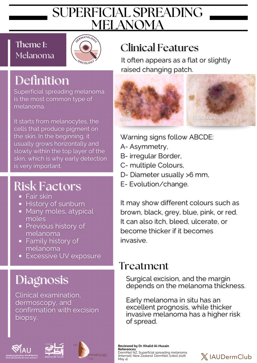 IAUDermClub's tweet photo. Superficial Spreading Melanoma is the most common type of melanoma and often begins as a changing flat spot on the skin. Early detection can make all the difference ✨
#IAUDermClub #DermatologicOncology https://t.co/Ik6ZI0gEfS