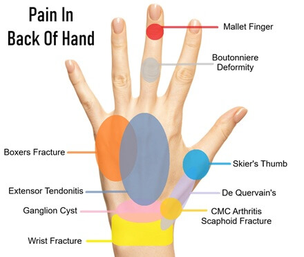 ShoulderPainExp's tweet photo. Pain In The Back Of Your Hand? Find out about the common causes and how best to treat them: https://t.co/XPh8EuXsRY https://t.co/SuVNymFBEW