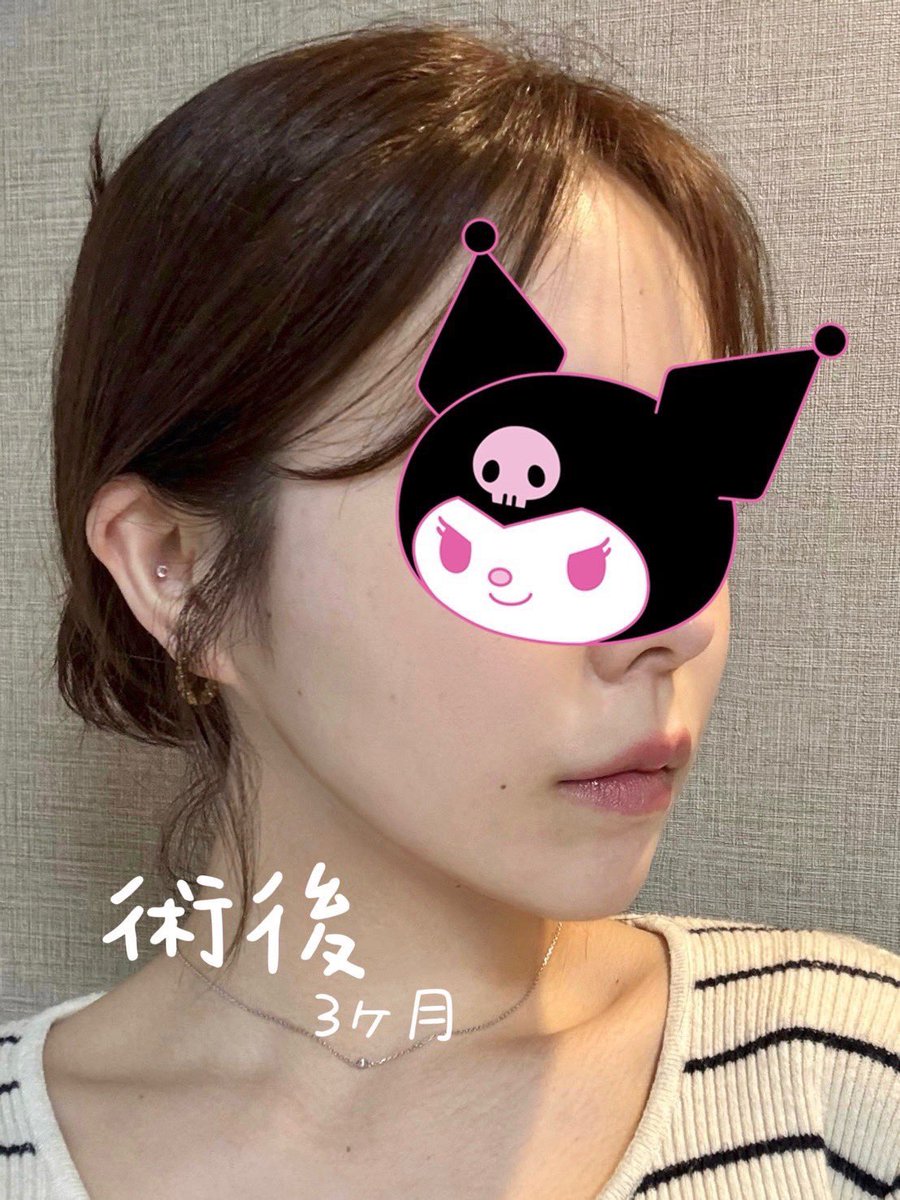 temporaryps's tweet photo. やっぱ脂肪吸引は糸リフトが必須な件。
(今のフェイスライン自分史上1番綺麗だし、無駄な余白ががギュッッと無くなって横顔がとにかく盛れます…） https://t.co/Pqz9xFpEux