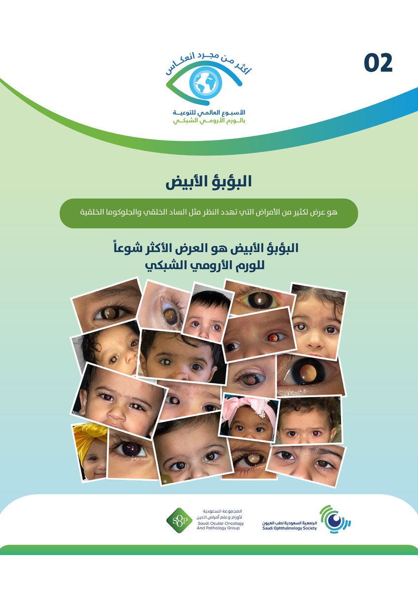 SOOPsos's tweet photo. البؤبؤ الأبيض 👁️

هو أكثر الأعراض شيوعًا للورم الأرومي الشبكي،وقد يظهر كانعكاس أبيض في عين الطفل بالصور أو الإضاءة.

فلا تهمل هذه العلامة…والفحص المبكر قد يحمي النظر وحياة الطفل بإذن الله.

#الورم_الأرومي_الشبكي#SaudiOphthalmolog https://t.co/rQ0OfseNzd