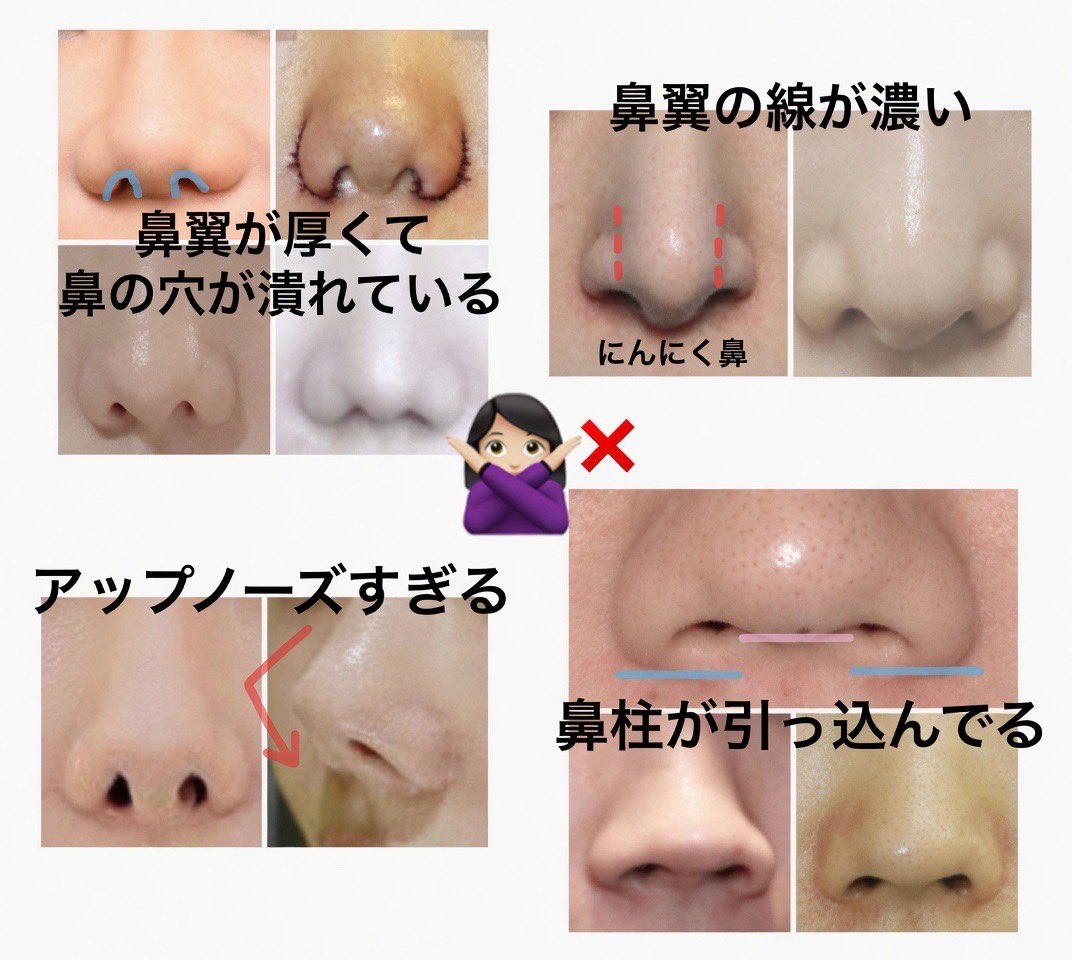 megasiras5's tweet photo. これら鼻中隔延長 鼻尖形成 小鼻縮小のどの資料見ても"なりたくない鼻"を徹底して伝える事の重要性が分かるんよ。

鼻整形は1mmが命取りになるから細かいニュアンスが伝わらなければそれが再手術の原因になり得るからね普通に。 https://t.co/5t1GirMtlS