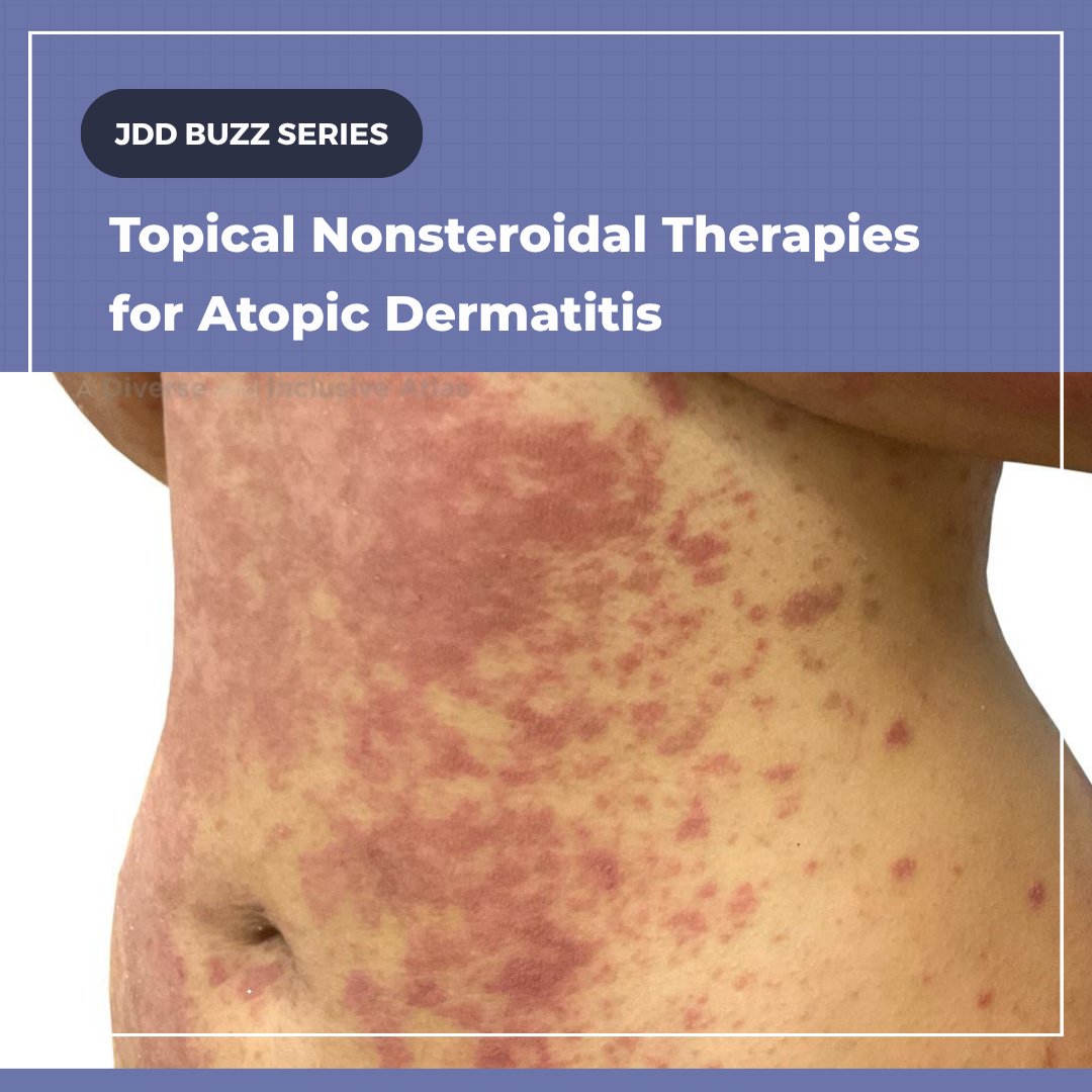 ODAC_Derm's tweet photo. A new paradigm in treating atopic dermatitis: https://t.co/Fa7iSpQLlb
#AtopicDermatitis https://t.co/lzVhJCQEFf