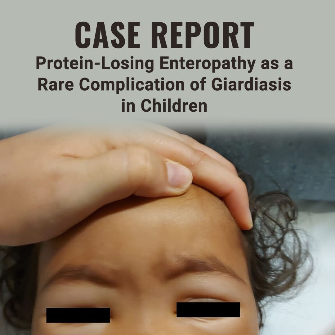 pediatriconcall's tweet photo. Pediatric Oncall Journal Publication
Case Report: Protein-Losing Enteropathy as a Rare Complication of Giardiasis in Children
https://t.co/WIERLV0mk9

#pediatrics #journal #pedjournal #pediatricjournal #casereport #Hypoalbuminemia #Giardiasis #ProteinLosingEnteropathy https://t.co/Ilk6UO5RZb