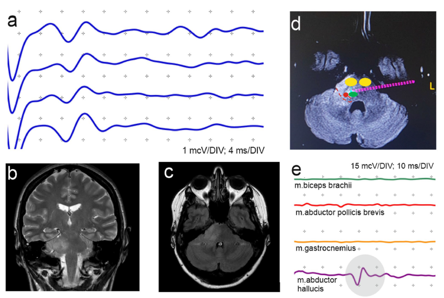 jasonpsheehan's tweet photo. Intraoperative mapping through a biopsy canula.  A new study in the Journal of Neuro-Oncology by Lapteva and colleagues. https://t.co/iUtO2VX6rs