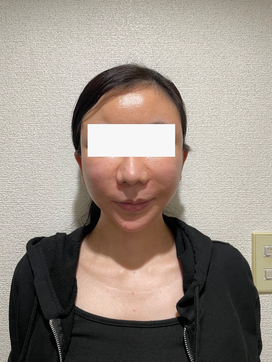 mmmpoopi's tweet photo. 術後1ヶ月経過。
かなり腫れが引きました���
耳の後ろの傷もキレイになってきました。
やっと鏡を見るのが楽しみになってきました。
#セミン整形外科 #整形垢 #韓国整形 
#切開リフト #フェイスリフト https://t.co/NQswRMOFH0
