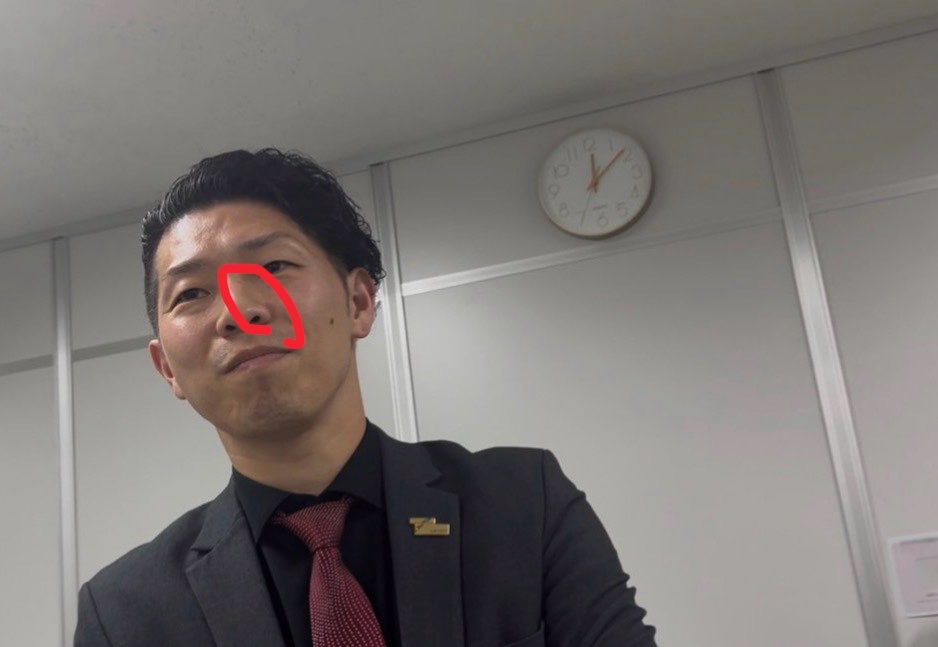 zenkokuspt's tweet photo. ホクロ除去すごい！
こんな綺麗になるんだ！
ホクロ取るお金あるなら被害者の皆さんにお金返しましょう！
#マルチ商法
#株式会社STONES https://t.co/H6hNWkw36B